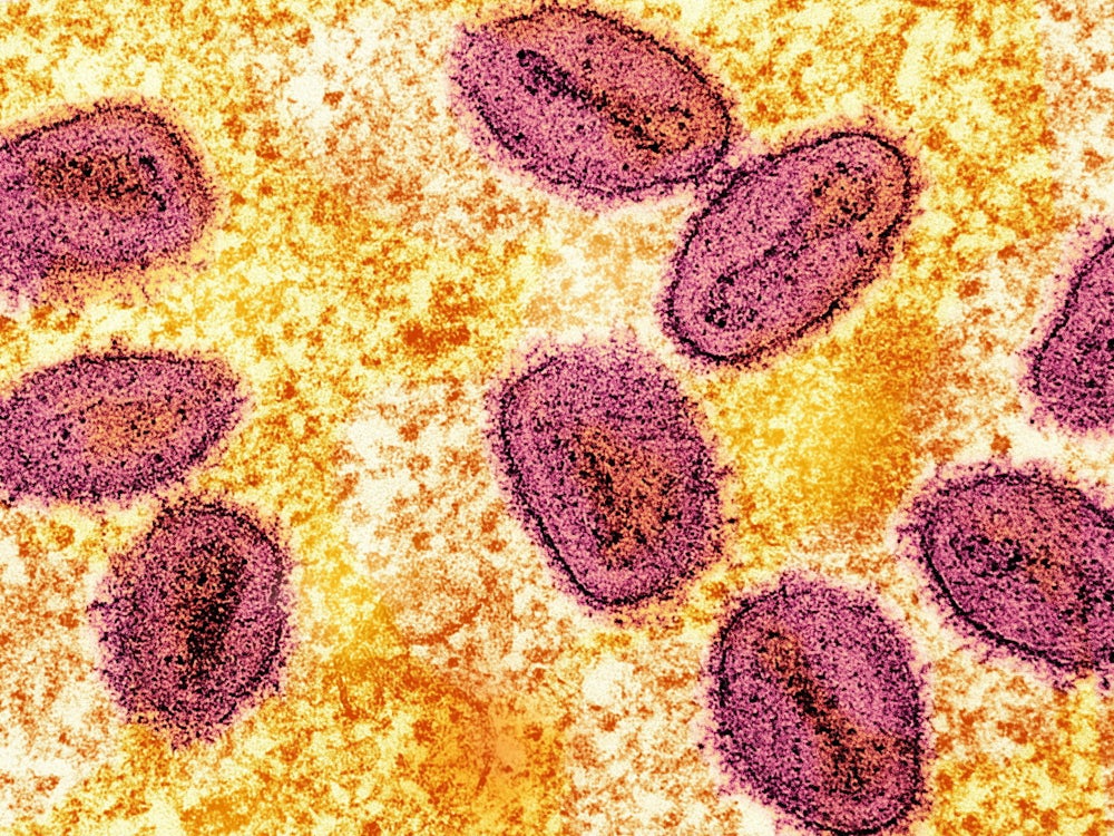 Infektionskrankheiten: Erster Fall Von Neuem Mpox Virustyp In Deutschland