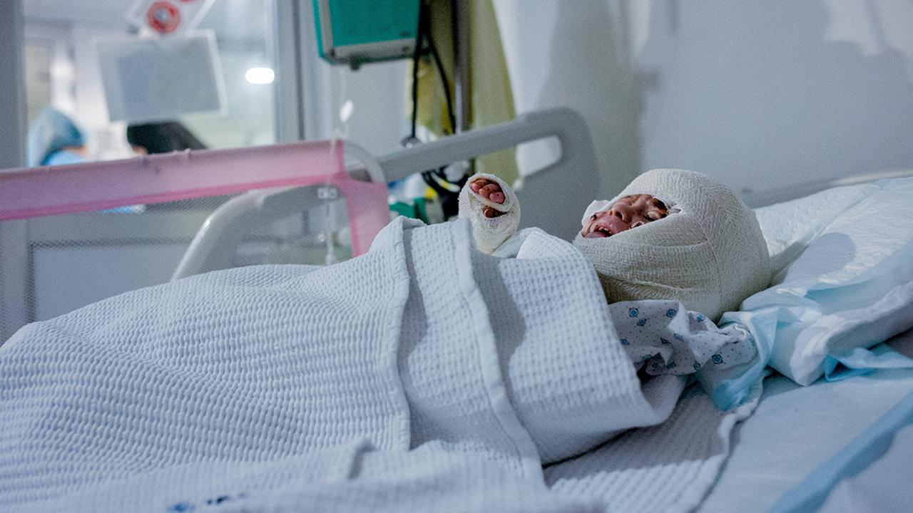 Zivile Opfer Im Krieg: Beiruts Klinik Der Verbrannten Kinder