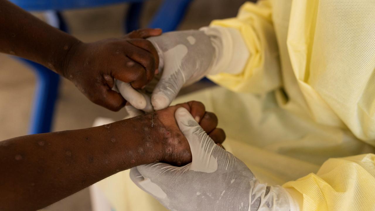 Mehr Als 1.000 Tote Durch Mpox In Afrika